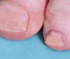 The same toenail growing out clear after laser treatment
