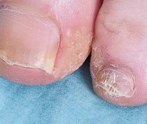 A toenail affected by fungal nail infection before treatment